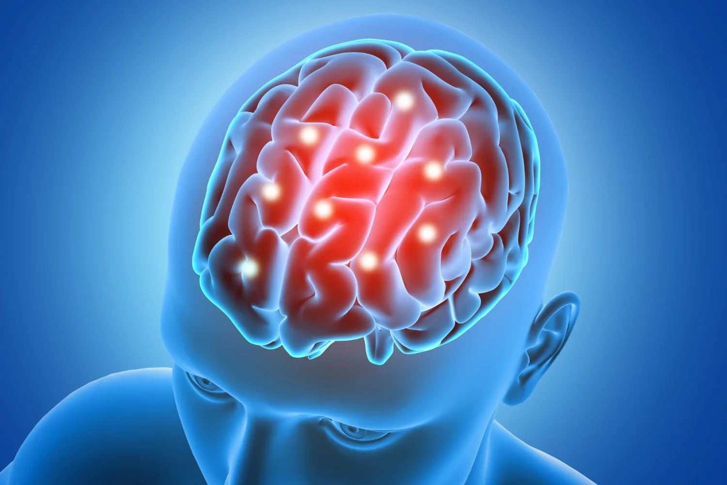 Tumores cerebrales